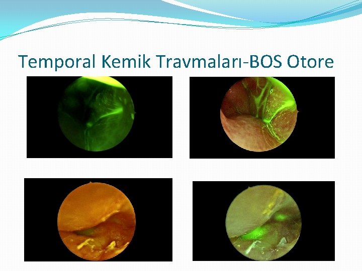 Temporal Kemik Travmaları-BOS Otore 