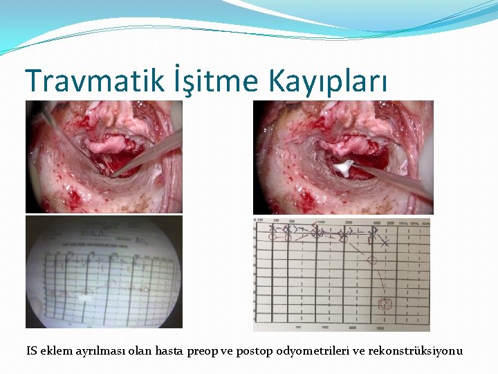 Travmatik İşitme Kayıpları IS eklem ayrılması olan hasta preop ve postop odyometrileri ve rekonstrüksiyonu