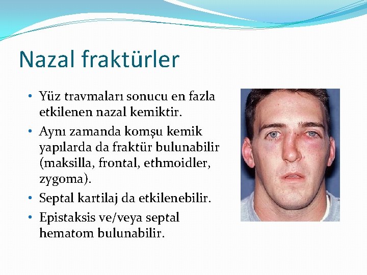 Nazal fraktürler • Yüz travmaları sonucu en fazla etkilenen nazal kemiktir. • Aynı zamanda