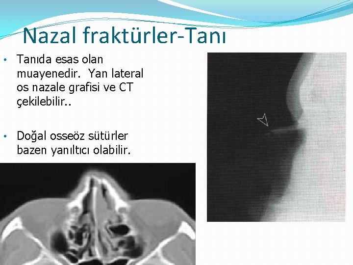 Nazal fraktürler-Tanı • Tanıda esas olan muayenedir. Yan lateral os nazale grafisi ve CT