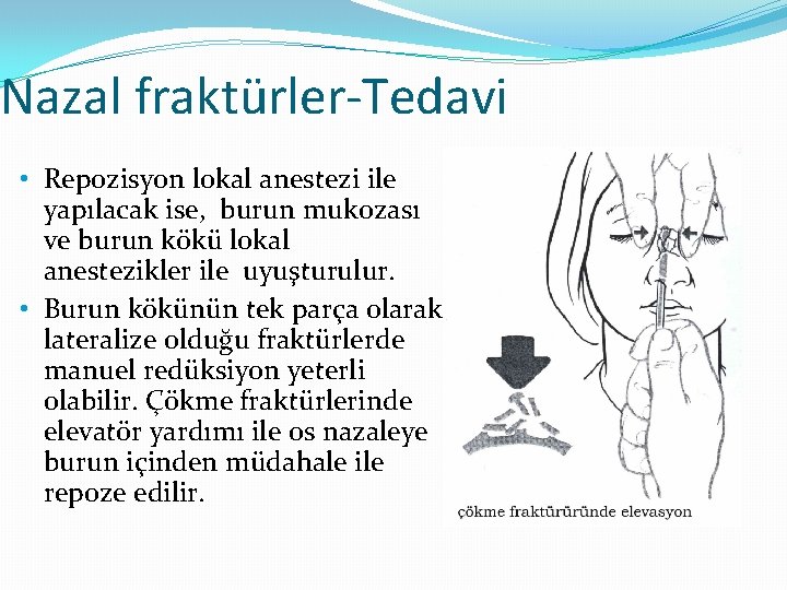 Nazal fraktürler-Tedavi • Repozisyon lokal anestezi ile yapılacak ise, burun mukozası ve burun kökü