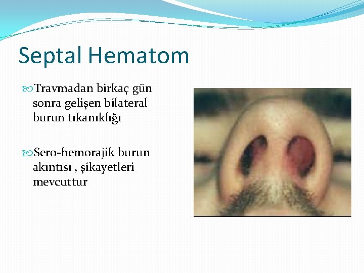 Septal Hematom Travmadan birkaç gün sonra gelişen bilateral burun tıkanıklığı Sero-hemorajik burun akıntısı ,
