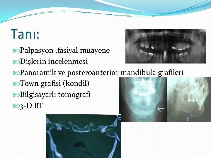 Tanı: Palpasyon , fasiyal muayene Dişlerin incelenmesi Panoramik ve posteroanterior mandibula grafileri Town grafisi