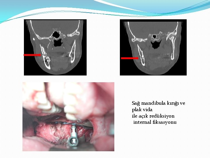 Sağ mandibula kırığı ve plak vida ile açık redüksiyon internal fiksasyonu 