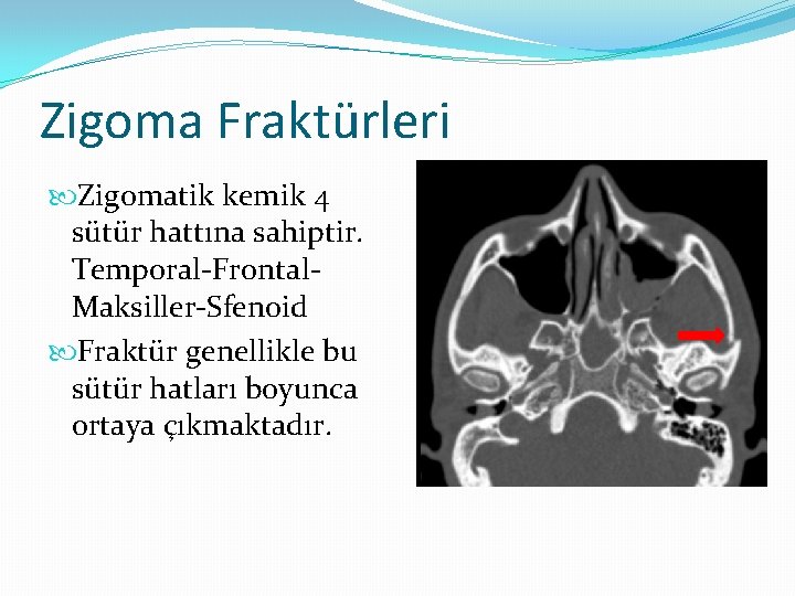 Zigoma Fraktürleri Zigomatik kemik 4 sütür hattına sahiptir. Temporal-Frontal. Maksiller-Sfenoid Fraktür genellikle bu sütür