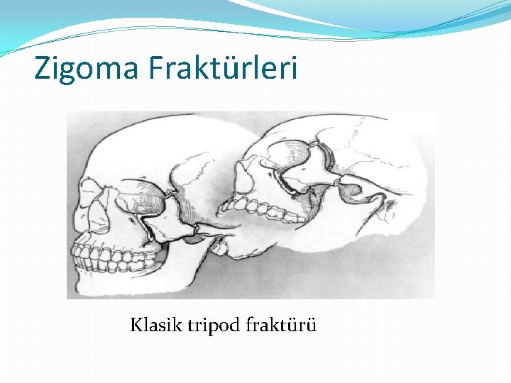 Zigoma Fraktürleri Klasik tripod fraktürü 