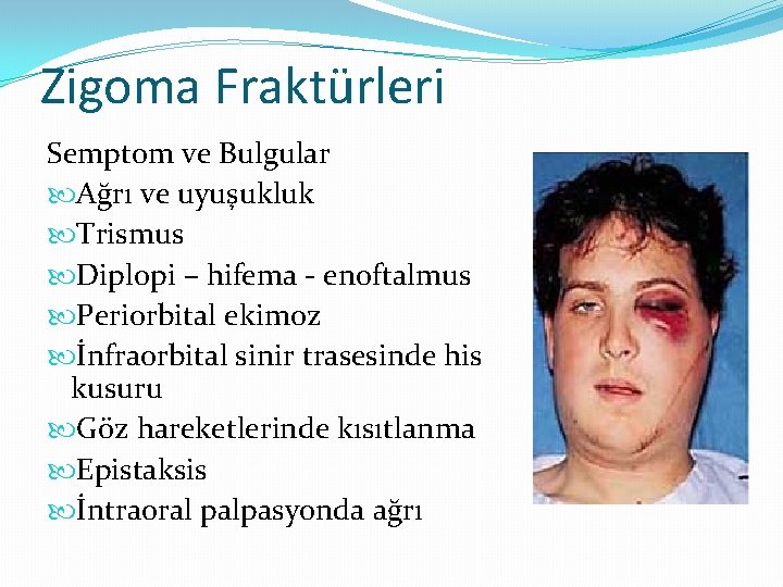 Zigoma Fraktürleri Semptom ve Bulgular Ağrı ve uyuşukluk Trismus Diplopi – hifema - enoftalmus