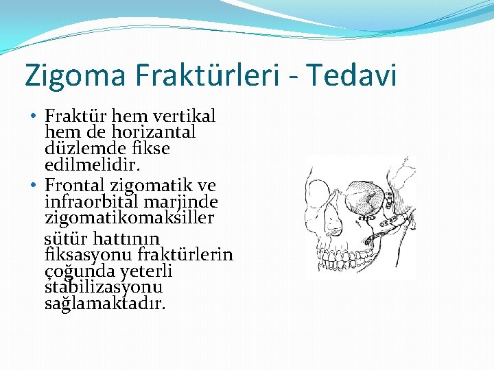 Zigoma Fraktürleri - Tedavi • Fraktür hem vertikal hem de horizantal düzlemde fikse edilmelidir.