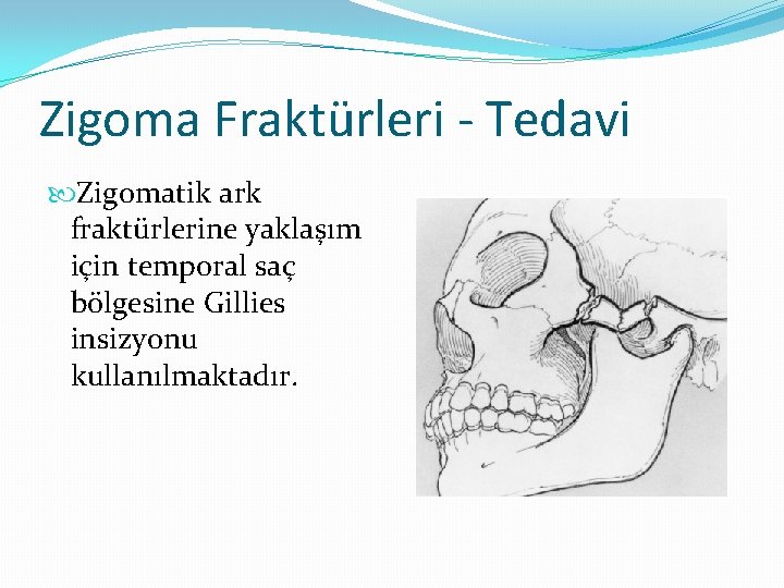 Zigoma Fraktürleri - Tedavi Zigomatik ark fraktürlerine yaklaşım için temporal saç bölgesine Gillies insizyonu