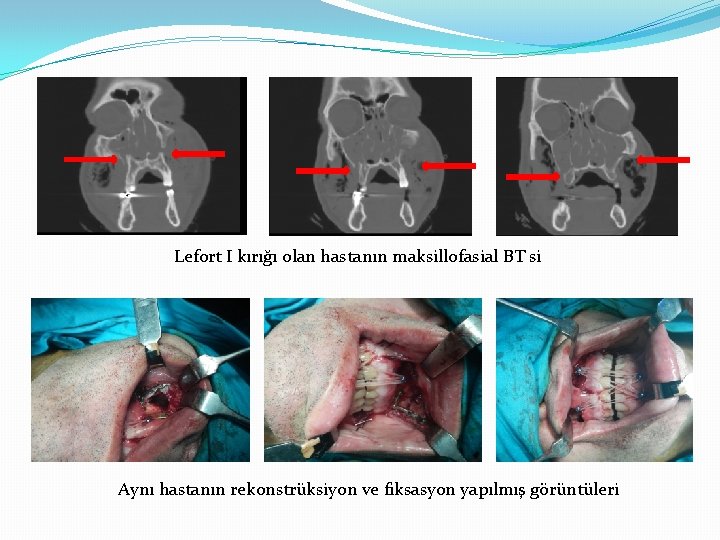 Lefort I kırığı olan hastanın maksillofasial BT si Aynı hastanın rekonstrüksiyon ve fiksasyon yapılmış