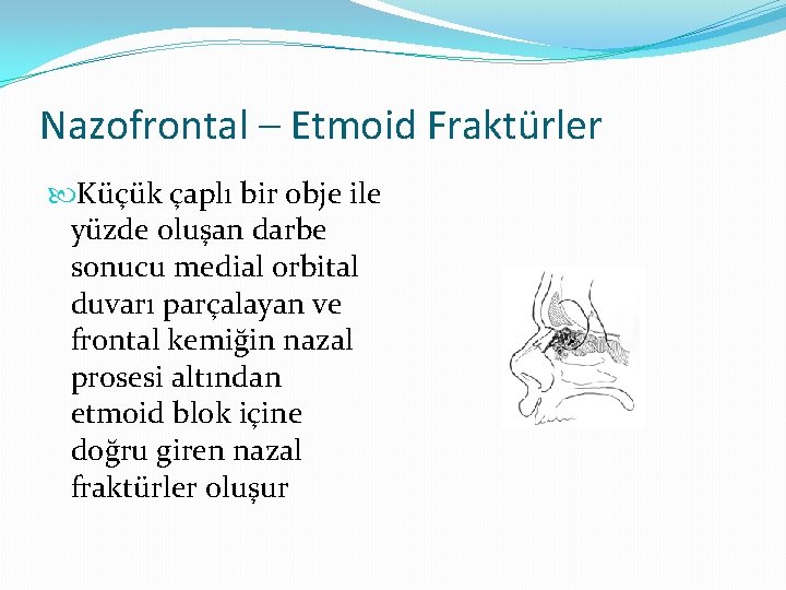 Nazofrontal – Etmoid Fraktürler Küçük çaplı bir obje ile yüzde oluşan darbe sonucu medial