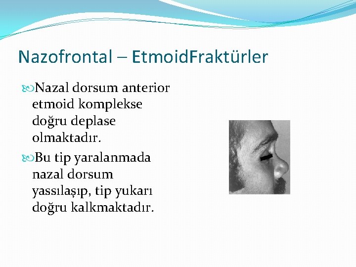 Nazofrontal – Etmoid. Fraktürler Nazal dorsum anterior etmoid komplekse doğru deplase olmaktadır. Bu tip