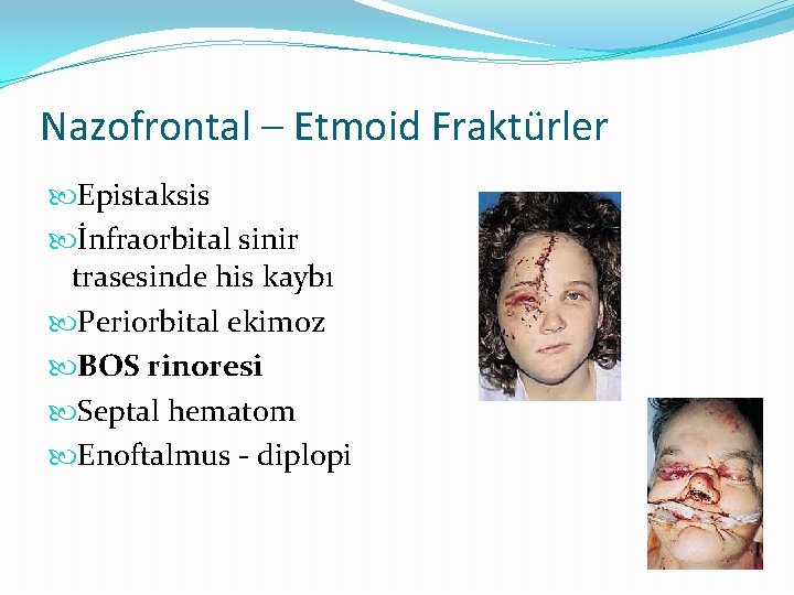 Nazofrontal – Etmoid Fraktürler Epistaksis İnfraorbital sinir trasesinde his kaybı Periorbital ekimoz BOS rinoresi