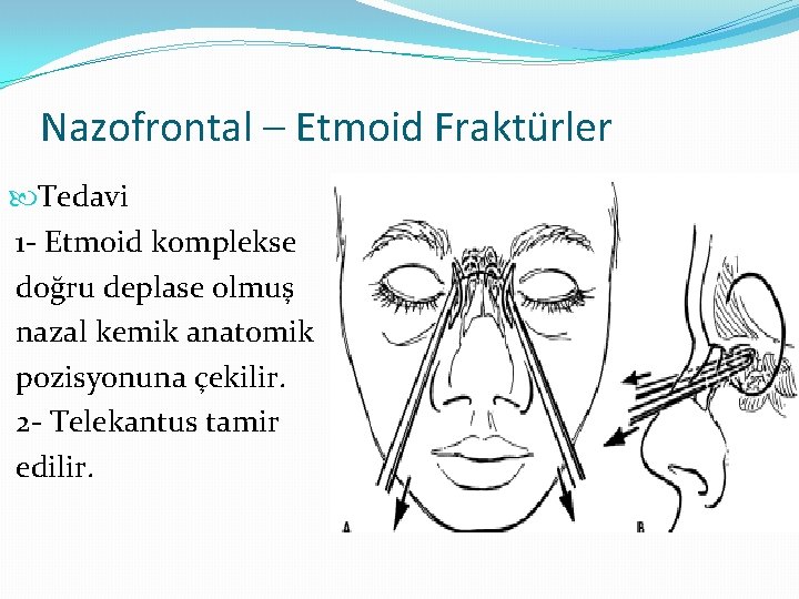 Nazofrontal – Etmoid Fraktürler Tedavi 1 - Etmoid komplekse doğru deplase olmuş nazal kemik