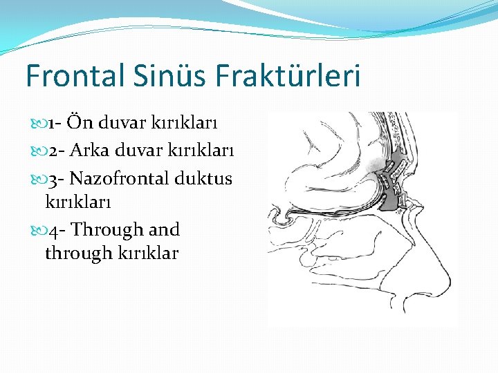 Frontal Sinüs Fraktürleri 1 - Ön duvar kırıkları 2 - Arka duvar kırıkları 3