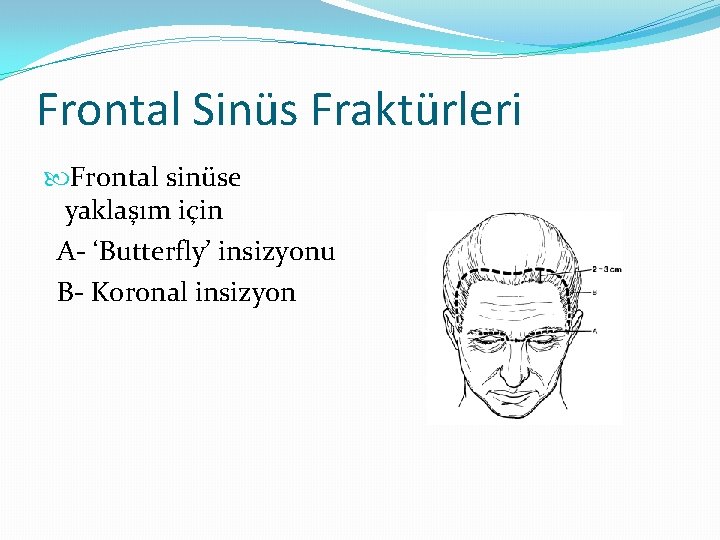 Frontal Sinüs Fraktürleri Frontal sinüse yaklaşım için A- ‘Butterfly’ insizyonu B- Koronal insizyon 