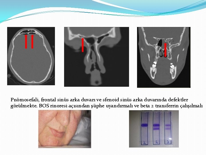 Pnömosefali, frontal sinüs arka duvarı ve sfenoid sinüs arka duvarında defektler görülmekte. BOS rinoresi