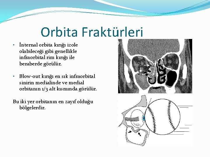 Orbita Fraktürleri • İnternal orbita kırığı izole olabileceği gibi genellikle infraorbital rim kırığı ile