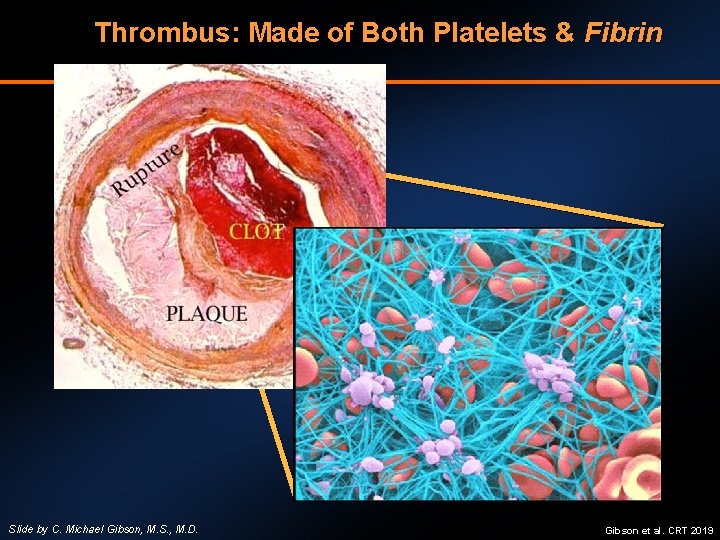 Thrombus: Made of Both Platelets & Fibrin Slide by C. Michael Gibson, M. S.