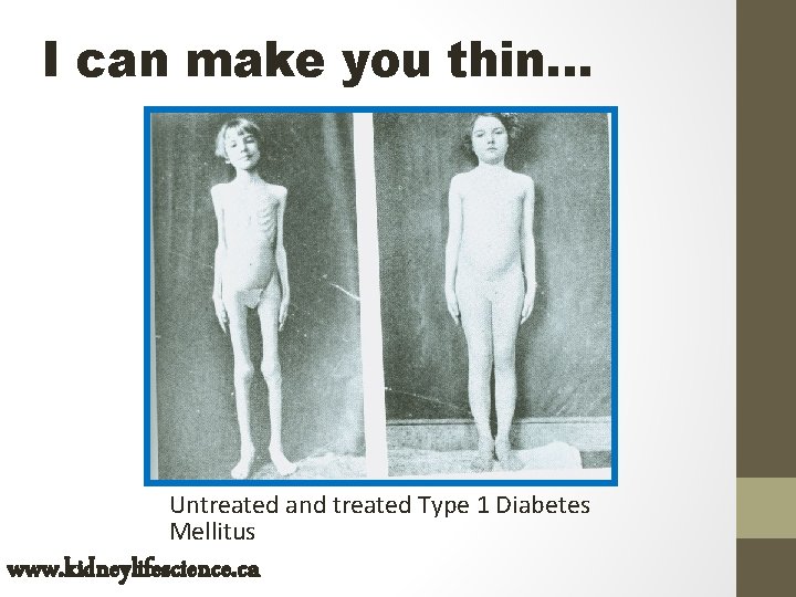 I can make you thin… Untreated and treated Type 1 Diabetes Mellitus www. kidneylifescience.