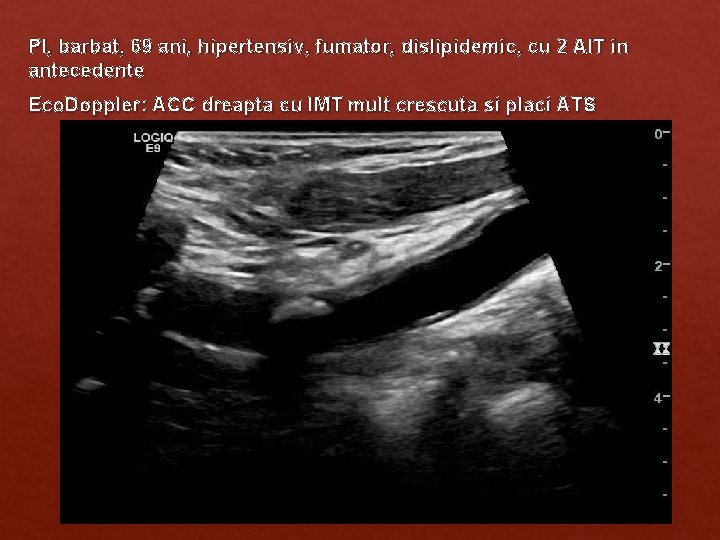 PI, barbat, 69 ani, hipertensiv, fumator, dislipidemic, cu 2 AIT in antecedente Eco. Doppler: PI, barbat, 69 ani, hipertensiv, fumator, dislipidemic, cu 2 AIT in antecedente Eco. Doppler: