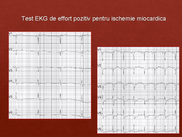Test EKG de effort pozitiv pentru ischemie miocardica Test EKG de effort pozitiv pentru ischemie miocardica