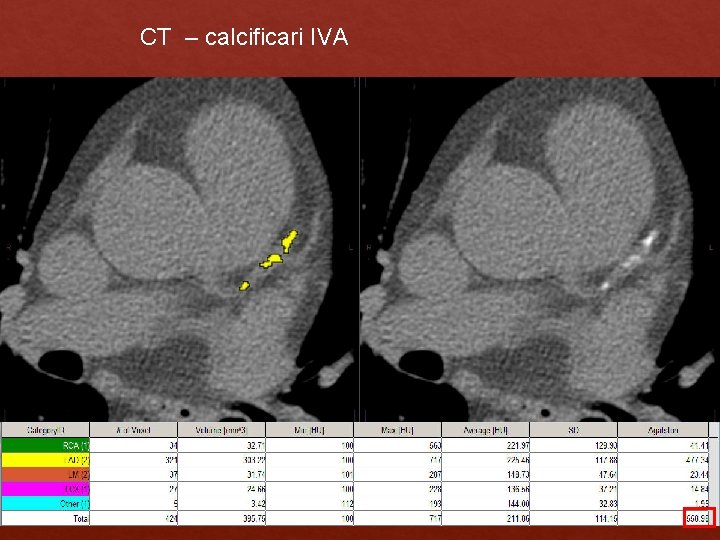 CT – calcificari IVA CT – calcificari IVA