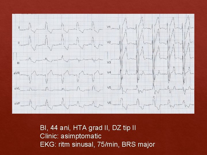 BI, 44 ani, HTA grad II, DZ tip II Clinic: asimptomatic EKG: ritm sinusal, BI, 44 ani, HTA grad II, DZ tip II Clinic: asimptomatic EKG: ritm sinusal,