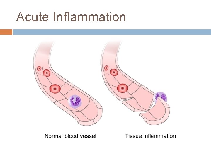 Acute Inflammation 