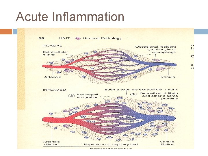 Acute Inflammation 