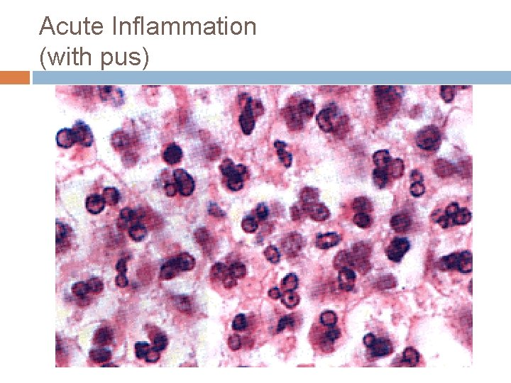 Acute Inflammation (with pus) 