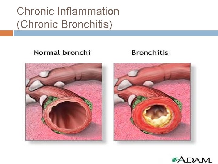 Chronic Inflammation (Chronic Bronchitis) 
