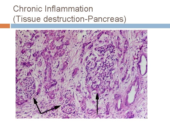 Chronic Inflammation (Tissue destruction-Pancreas) 