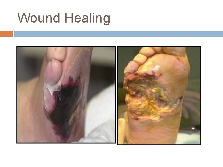 Wound Healing 