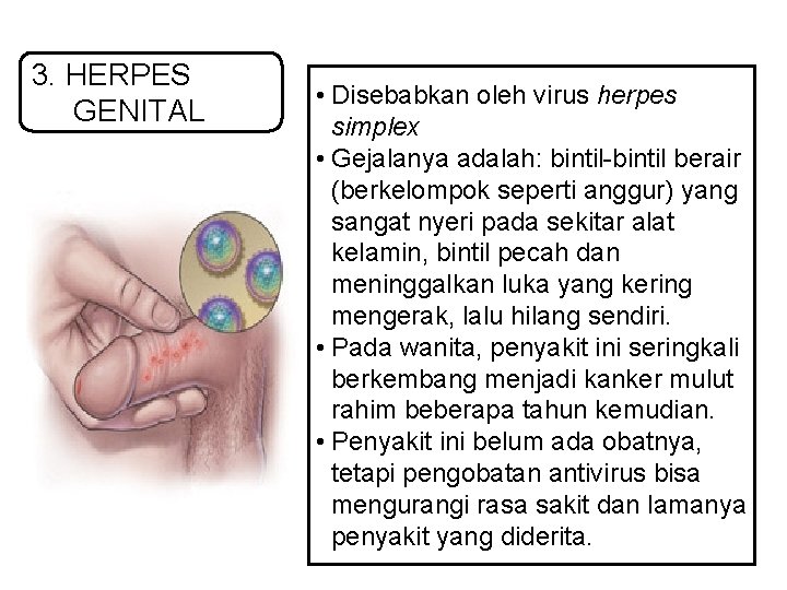 3. HERPES GENITAL • Disebabkan oleh virus herpes simplex • Gejalanya adalah: bintil-bintil berair