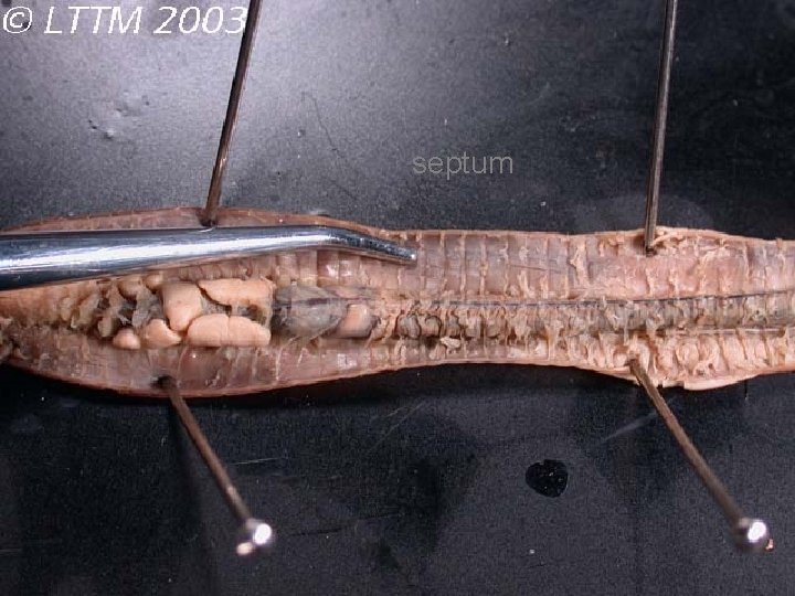 septum 