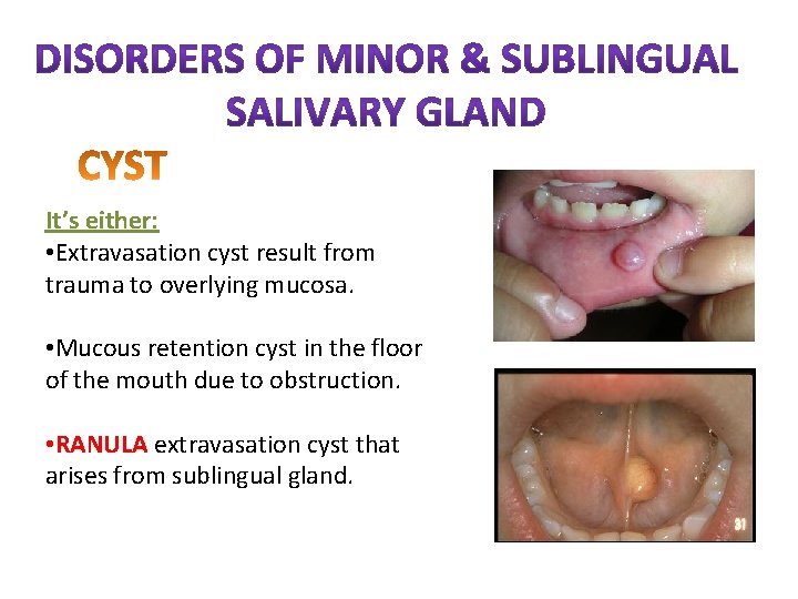 It’s either: • Extravasation cyst result from trauma to overlying mucosa. • Mucous retention