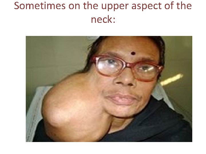 Sometimes on the upper aspect of the neck: 