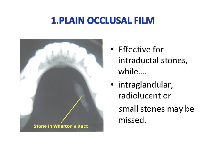 1. PLAIN OCCLUSAL FILM • Effective for intraductal stones, while…. • intraglandular, radiolucent or