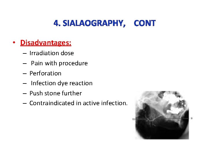 4. SIALAOGRAPHY, CONT • Disadvantages: – – – Irradiation dose Pain with procedure Perforation