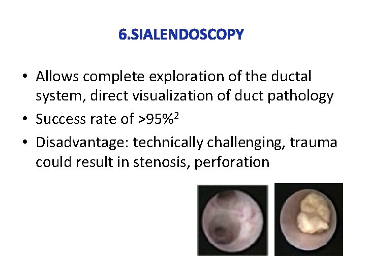 6. SIALENDOSCOPY • Allows complete exploration of the ductal system, direct visualization of duct