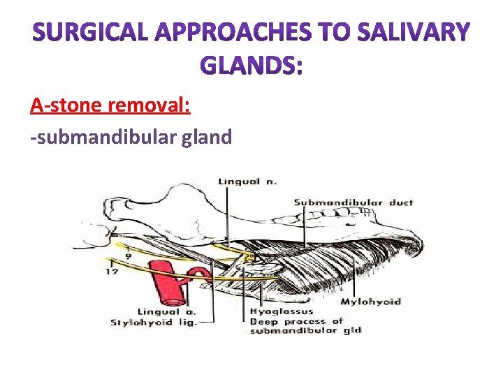 A-stone removal: -submandibular gland 