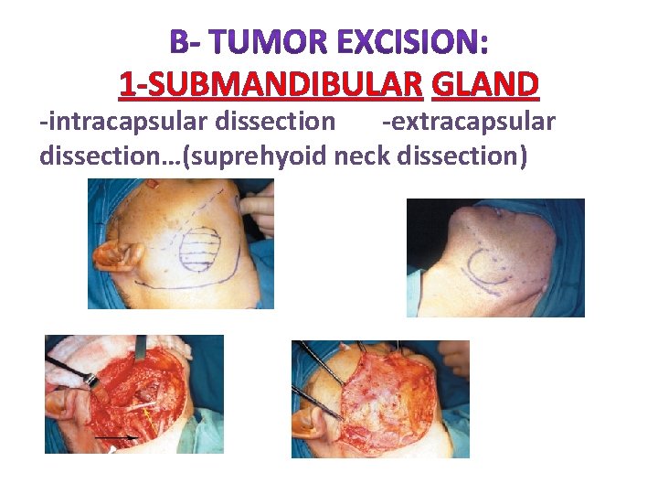 1 -SUBMANDIBULAR GLAND -intracapsular dissection -extracapsular dissection…(suprehyoid neck dissection) 