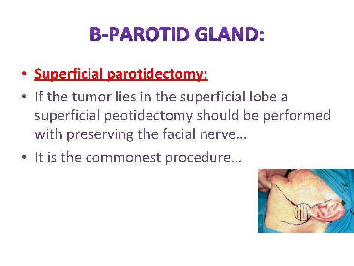  • Superficial parotidectomy: • If the tumor lies in the superficial lobe a