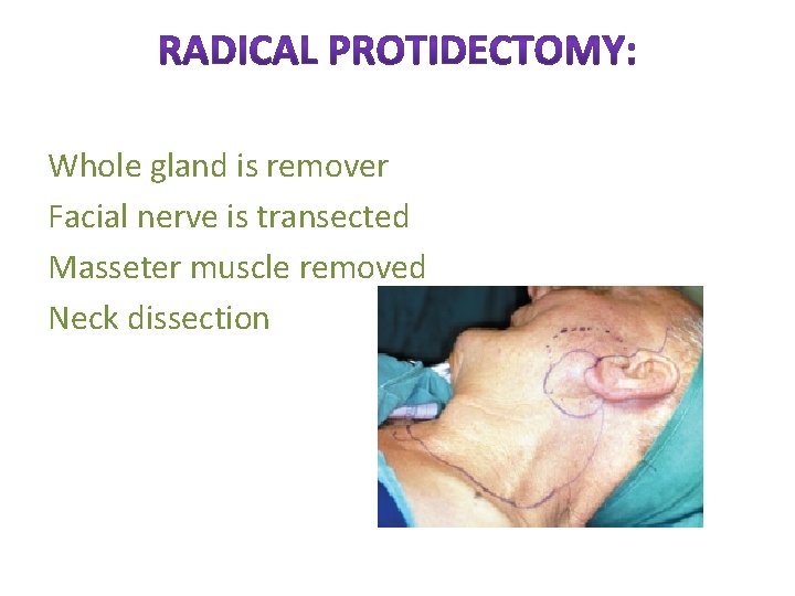 Whole gland is remover Facial nerve is transected Masseter muscle removed Neck dissection 