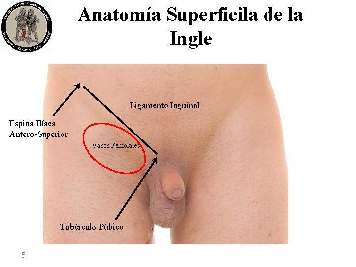 Anatomía Superficila de la Ingle Ligamento Inguinal Espina Ilíaca Antero-Superior Vasos Femorales Tubérculo Púbico