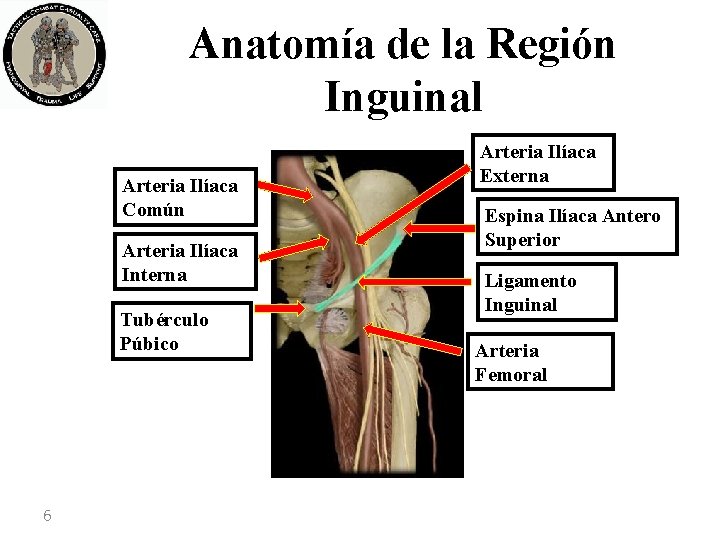 Anatomía de la Región Inguinal Arteria Ilíaca Común Arteria Ilíaca Interna Tubérculo Púbico 6