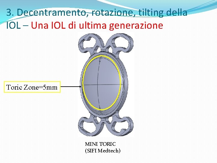 3. Decentramento, rotazione, tilting della IOL – Una IOL di ultima generazione Toric Zone=5