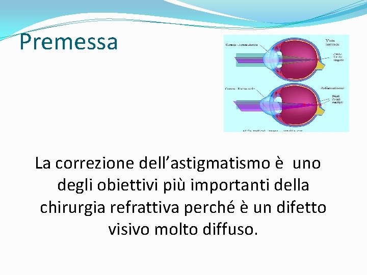 Premessa La correzione dell’astigmatismo è uno degli obiettivi più importanti della chirurgia refrattiva perché