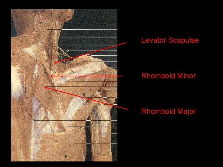 Levator Scapulae Rhomboid Minor Rhomboid Major 